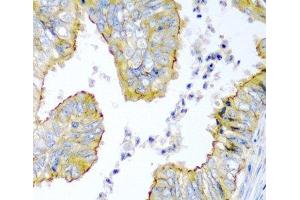 Immunohistochemistry of paraffin-embedded Human colon carcinoma using KRBOX4 Polyclonal Antibody at dilution of 1:200 (40x lens).