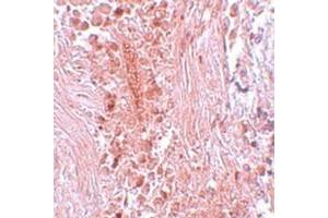 Immunohistochemical staining of human breast cancer tissue with PIAS3 polyclonal antibody  at 5 ug/mL dilution.