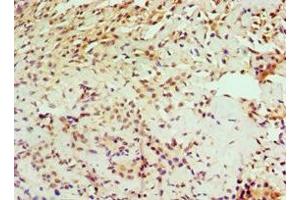 Immunohistochemistry of paraffin-embedded human breast cancer using ABIN7156734 at dilution of 1:100 (IL1RAP Antikörper  (AA 21-356))