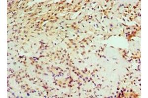 Immunohistochemistry of paraffin-embedded human breast cancer using ABIN7156734 at dilution of 1:100