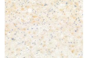 ABIN6261291 and ABIN6279349 at 1/100 staining human astrocytoma by IHC-P. (DHRS7 Antikörper  (C-Term))