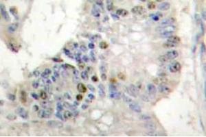 Immunohistochemistry (IHC) analyzes of Histone H1 antibody in paraffin-embedded human colon carcinoma tissue. (Histone H1 Antikörper)