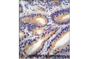 HSD11B1L Antibody (C-term) (ABIN655425 and ABIN2844963) immunohistochemistry analysis in formalin fixed and paraffin embedded human prostate carcinoma followed by peroxidase conjugation of the secondary antibody and DAB staining.
