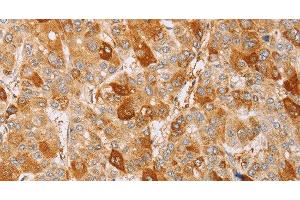 Immunohistochemistry of paraffin-embedded Human liver cancer using CDC46 Polyclonal Antibody at dilution of 1:40 (MCM5 Antikörper)