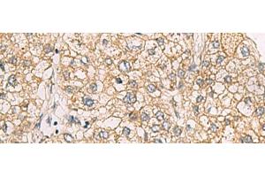 Immunohistochemistry of paraffin-embedded Human liver cancer tissue using CHST2 Polyclonal Antibody at dilution of 1:30(x200) (CHST2 Antikörper)