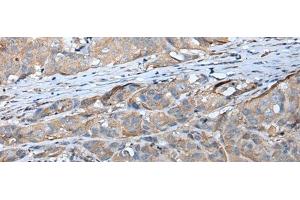Immunohistochemistry of paraffin-embedded Human breast cancer tissue using GPC5 Polyclonal Antibody at dilution of 1:40(x200) (GPC5 Antikörper)
