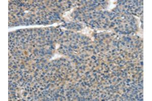The image on the left is immunohistochemistry of paraffin-embedded Human liver cancer tissue using ABIN7128589(ATP4B Antibody) at dilution 1/40, on the right is treated with fusion protein. (ATP4b Antikörper)