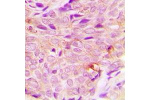 Immunohistochemical analysis of PIGF staining in human breast cancer formalin fixed paraffin embedded tissue section.