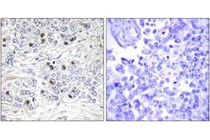 Immunohistochemistry analysis of paraffin-embedded human breast carcinoma tissue, using TEAD2 Antibody. (TEAD2 Antikörper  (AA 71-120))