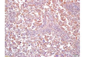 Formalin-fixed and paraffin embedded human lung carcinoma labeled with Anti MT-ND5Polyclonal Antibody (ABIN751633), Unconjugated at 1:200, followed by conjugation to the secondary antibody and DAB staining (MT-ND5 Antikörper  (AA 451-550))