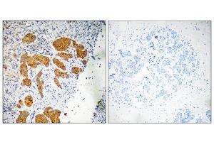 Immunohistochemistry analysis of paraffin-embedded human breast carcinoma tissue, using CKLF4 antibody. (CKLF Antikörper  (Internal Region))