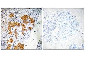 Immunohistochemistry analysis of paraffin-embedded human breast carcinoma tissue, using CKLF4 antibody.