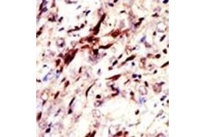 Formalin-fixed and paraffin-embedded human cancer tissue reacted with the primary antibody, which was peroxidase-conjugated to the secondary antibody, followed by AEC staining. (Pan SUMO (SUMO (pan)) Antikörper)