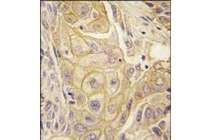 Formalin-fixed and paraffin-embedded human lung carcinoma tissue reacted with EphB2 antibody, which was peroxidase-conjugated to the secondary antibody, followed by DAB staining.