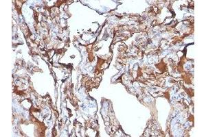 Formalin-fixed, paraffin-embedded human melanoma stained with CD146 antibody (MUC18/1130) (MCAM Antikörper)