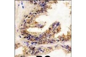 Formalin-fixed and paraffin-embedded human prostata carcinoma reacted with BRAF Antibody (Center) (ABIN392246 and ABIN2841936) , which was peroxidase-conjugated to the secondary antibody, followed by DAB staining. (SNRPE Antikörper  (AA 424-453))