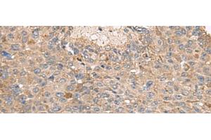 Immunohistochemistry of paraffin-embedded Human liver cancer tissue using ABCA10 Polyclonal Antibody at dilution of 1:50(x200) (ABCA10 Antikörper)