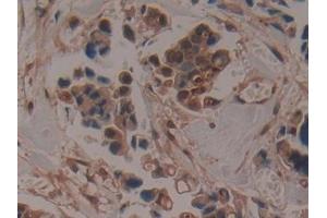 Detection of ADAMTS5 in Human Breast cancer Tissue using Polyclonal Antibody to A Disintegrin And Metalloproteinase With Thrombospondin 5 (ADAMTS5) (ADAMTS5 Antikörper  (AA 485-622))