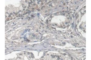 Detection of FBLN1 in Human Prostate Tissue using Monoclonal Antibody to Fibulin 1 (FBLN1) (Fibulin 1 Antikörper  (AA 176-398))