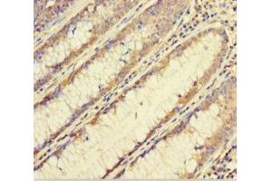 Immunohistochemistry of paraffin-embedded human colon cancer using ABIN7152460 at dilution of 1:100 (FBXL17 Antikörper  (AA 1-303))