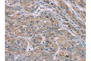 The image on the left is immunohistochemistry of paraffin-embedded Human liver cancer tissue using ABIN7192260(SAMD9 Antibody) at dilution 1/35, on the right is treated with synthetic peptide. (SAMD9 Antikörper)