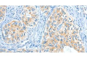 Immunohistochemistry of paraffin-embedded Human cervical cancer tissue using COL4A2 Polyclonal Antibody at dilution 1:70 (COL4a2 Antikörper)