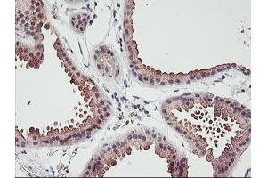 Immunohistochemical staining of paraffin-embedded Human breast tissue using anti-ERCC1 mouse monoclonal antibody. (ERCC1 Antikörper)