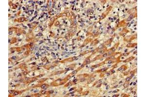 Immunohistochemistry of paraffin-embedded human liver cancer using ABIN7156663 at dilution of 1:100 (IFIT1 Antikörper  (AA 1-181))