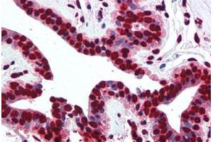 Human Breast (formalin-fixed, paraffin-embedded) stained with Histone H2A antibody ABIN291582 at 5 ug/ml followed by biotinylated goat anti-rabbit IgG secondary antibody ABIN481713, alkaline phosphatase-streptavidin and chromogen. (Histone H2A Antikörper  (AA 1-15))