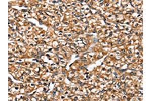 The image on the left is immunohistochemistry of paraffin-embedded Human prostate cancer tissue using ABIN7192449(SLC26A5 Antibody) at dilution 1/20, on the right is treated with synthetic peptide. (SLC26A5 Antikörper)