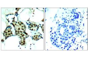 Immunohistochemical analysis of paraffin-embedded human breast carcinoma tissue, using P38 MAPK (phospho- Tyr182) antibody (E011253). (MAPK14 Antikörper  (pTyr182))