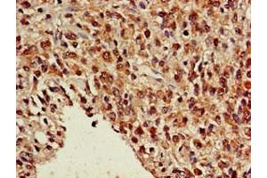 Immunohistochemistry of paraffin-embedded human glioma using ABIN7161911 at dilution of 1:100 (NR5A2 + LRH1 Antikörper  (AA 182-291))