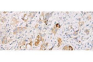 Immunohistochemistry of paraffin-embedded Human liver cancer tissue using DHRS2 Polyclonal Antibody at dilution of 1:50(x200) (DHRS2 Antikörper)