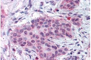 Human Breast Carcinoma (formalin-fixed, paraffin-embedded) stained with MMP13 antibody ABIN301763 at 17 ug/ml followed by biotinylated goat anti-rabbit IgG secondary antibody ABIN481713, alkaline phosphatase-streptavidin and chromogen. (MMP13 Antikörper  (N-Term))