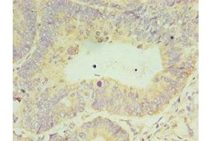 Immunohistochemistry of paraffin-embedded human colon cancer using ABIN7150731 at dilution of 1:100 (CLK2 Antikörper  (AA 240-499))