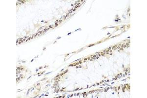 Immunohistochemistry of paraffin-embedded Human colon carcinoma using HIRA Polyclonal Antibody at dilution of 1:100 (40x lens). (HIRA Antikörper)