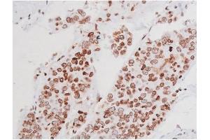 ABIN6267365 at 1/200 staining Human liver cancer tissue sections by IHC-P.