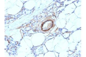 Formalin-fixed, paraffin-embedded human Angiosarcoma stained with SM-MHC Mouse Monoclonal Antibody (MYH11/923). (MYH11 Antikörper)