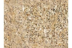 MED13L Mouse Monoclonal Antibody at 1/100 staining human gastric cancer by IHC-P.