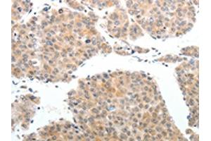 The image on the left is immunohistochemistry of paraffin-embedded Human liver cancer tissue using ABIN7189608(ABL2 Antibody) at dilution 1/25, on the right is treated with synthetic peptide. (ABL2 Antikörper)
