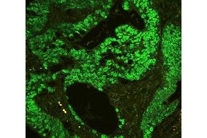 IF analysis of CTBP2 using anti-CTBP2 antibody (ABIN3042768) P-cadherin was detected in paraffin-embedded section of human colon cancer tissues.