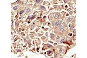 IHC analysis of FFPE human hepatocarcinoma tissue stained with the ALK2 antibody (ACVR1 Antikörper  (AA 132-162))
