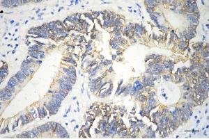 Immunohistochemistry was performed on paraffin-embedded human sigmoid colon carcinoma using catenin beta 1 antibody (ABIN7797927), 1:200). (CTNNB1 Antikörper)