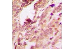 Immunohistochemical analysis of p38 (pT180/Y182) staining in human breast cancer formalin fixed paraffin embedded tissue section.