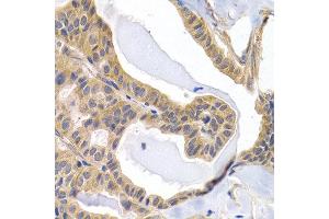 Immunohistochemistry of paraffin-embedded human thyroid cancer using PTGIR antibody at dilution of 1:200 (400x lens). (Prostacyclin Receptor Antikörper)