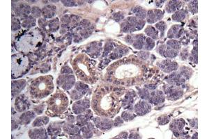 IHC-P Image Immunohistochemical analysis of human salivary gland cancer, using MMP3, antibody at 1:100 dilution. (MMP3 Antikörper  (N-Term))