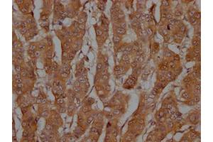 IHC image of ABIN7127776 diluted at 1:100 and staining in paraffin-embedded human breast cancer performed on a Leica BondTM system.