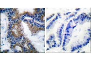 Immunohistochemistry analysis of paraffin-embedded human lung carcinoma, using CrkL (Phospho-Tyr207) Antibody. (CrkL Antikörper  (pTyr207))
