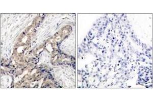 Immunohistochemistry analysis of paraffin-embedded human breast carcinoma, using Abl (Phospho-Tyr393/412) Antibody. (ABL1 Antikörper  (pTyr393))