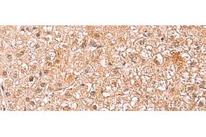 Immunohistochemistry of paraffin-embedded Human liver cancer tissue using ASTN2 Polyclonal Antibody at dilution of 1:80(x200) (Astrotactin 2 Antikörper)